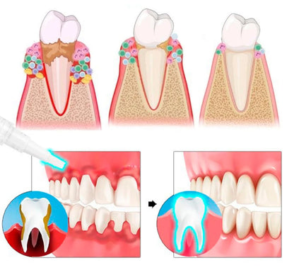 Gum-Protect | Revitalizes Gums & Whitens Teeth Within The First Week