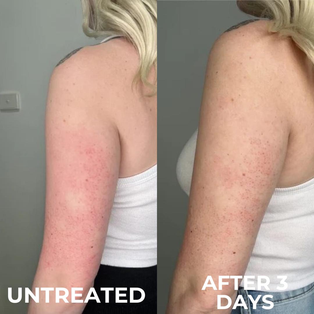 Strawberry | Reduce Redness, Inflammation & Bumps In 4 Days