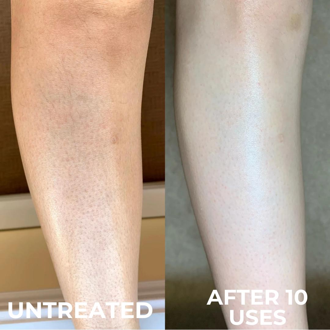 Strawberry | Reduce Redness, Inflammation & Bumps In 4 Days