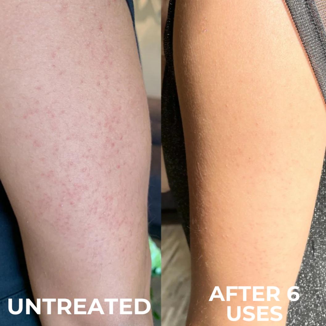 Strawberry | Reduce Redness, Inflammation & Bumps In 4 Days