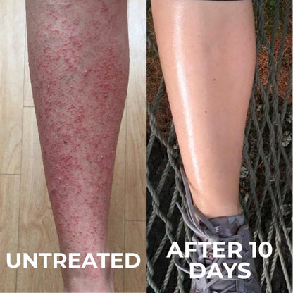 Strawberry | Reduce Redness, Inflammation & Bumps In 4 Days