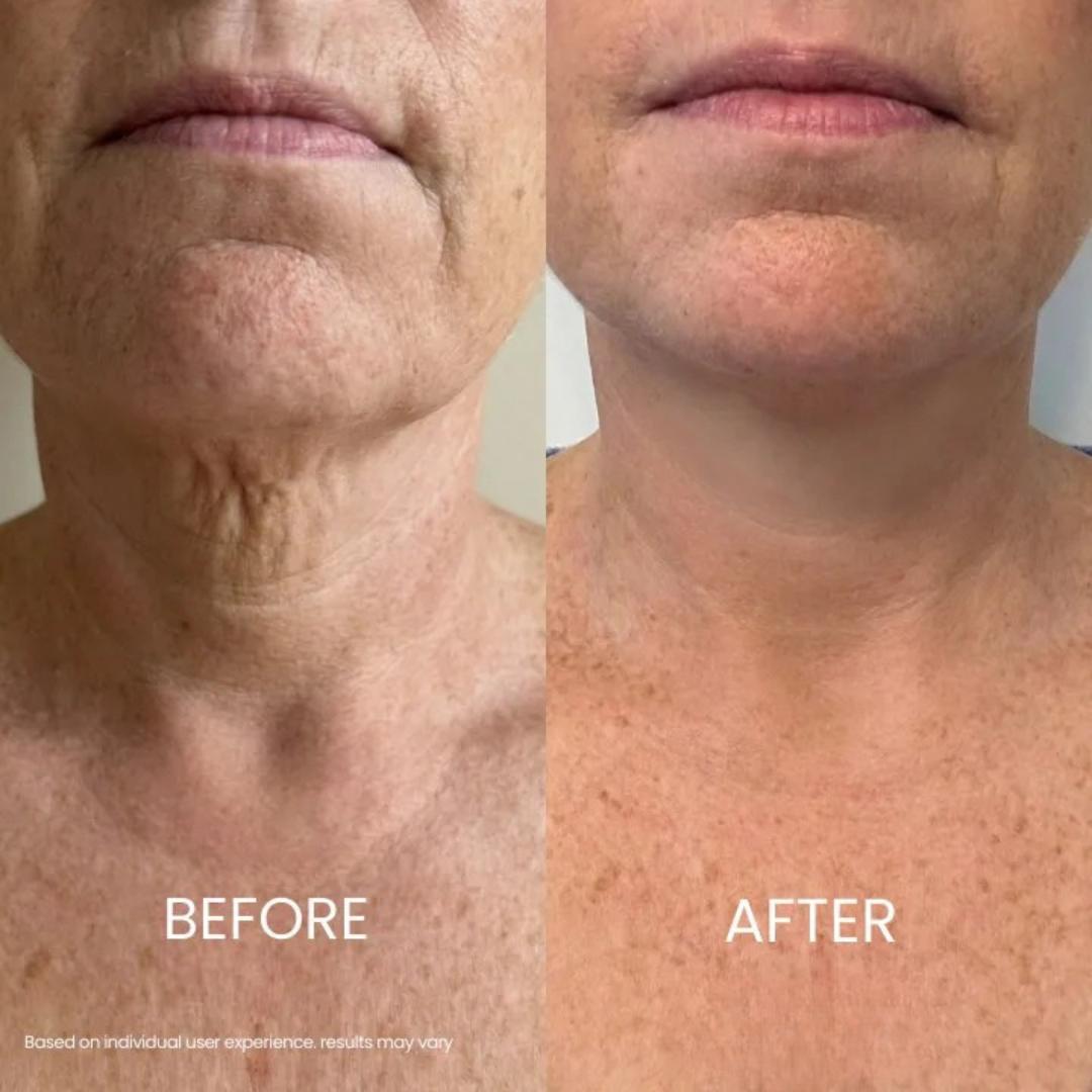 Zyrenol® | Tightening & Lifting Neck Cream