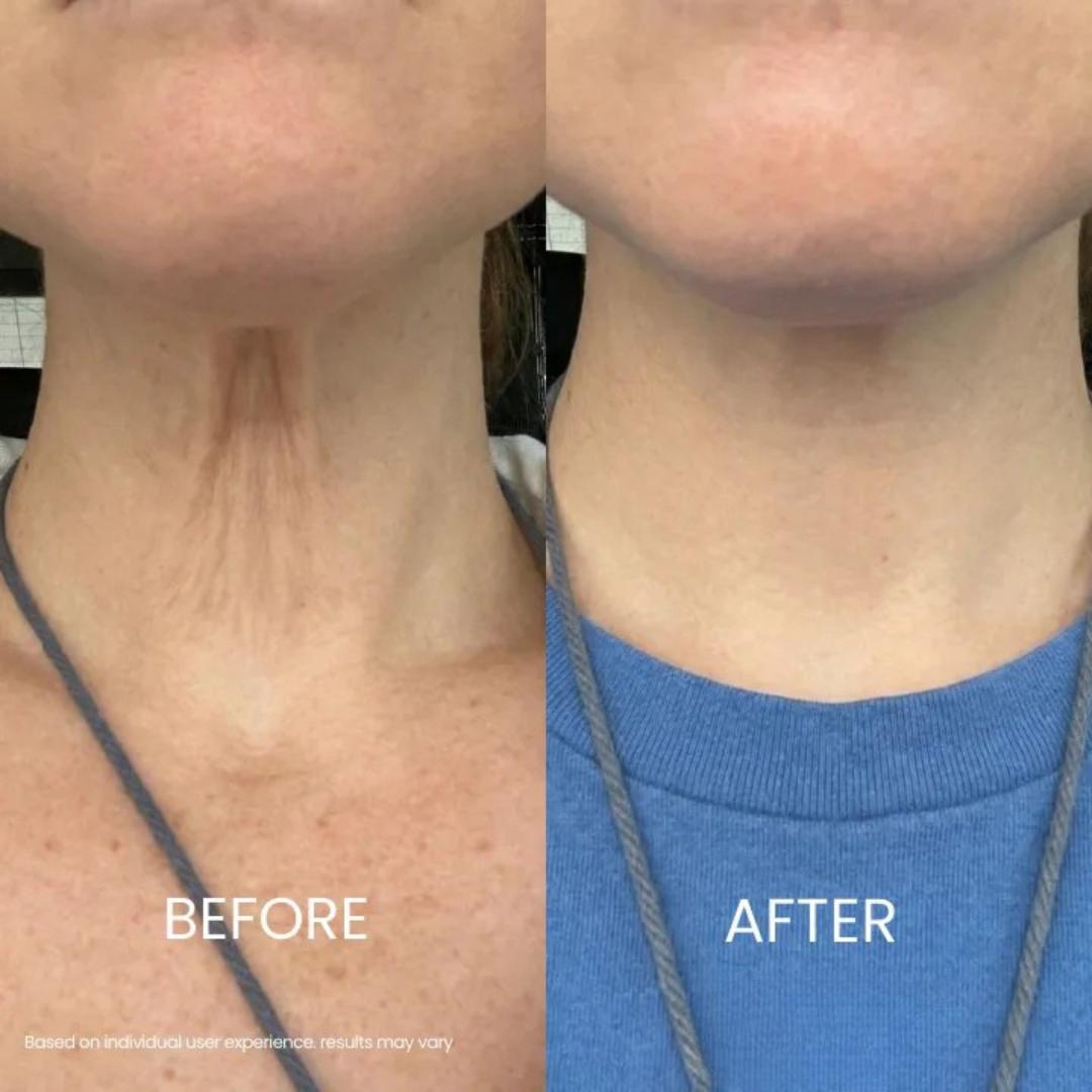 Zyrenol® | Tightening & Lifting Neck Cream