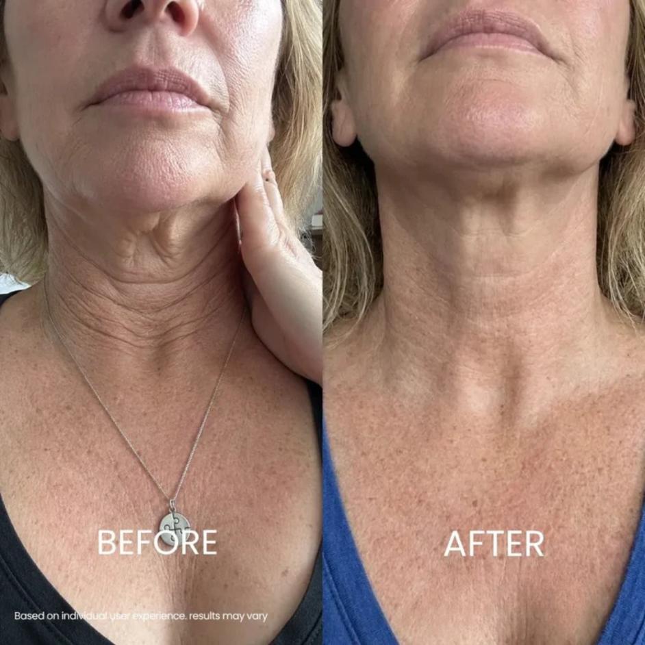 Zyrenol® | Tightening & Lifting Neck Cream